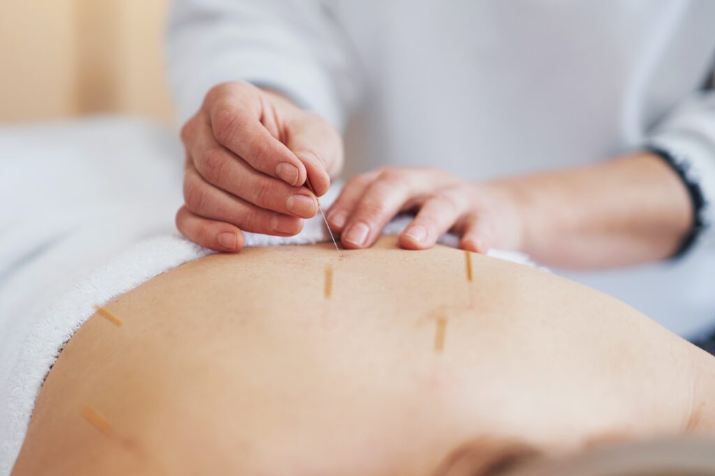 A acupuncture needle therapy in the studio