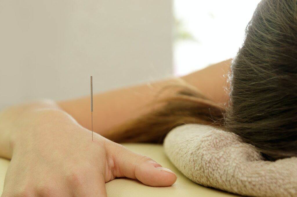 Female hand with steel needles during procedure of acupuncture therapy