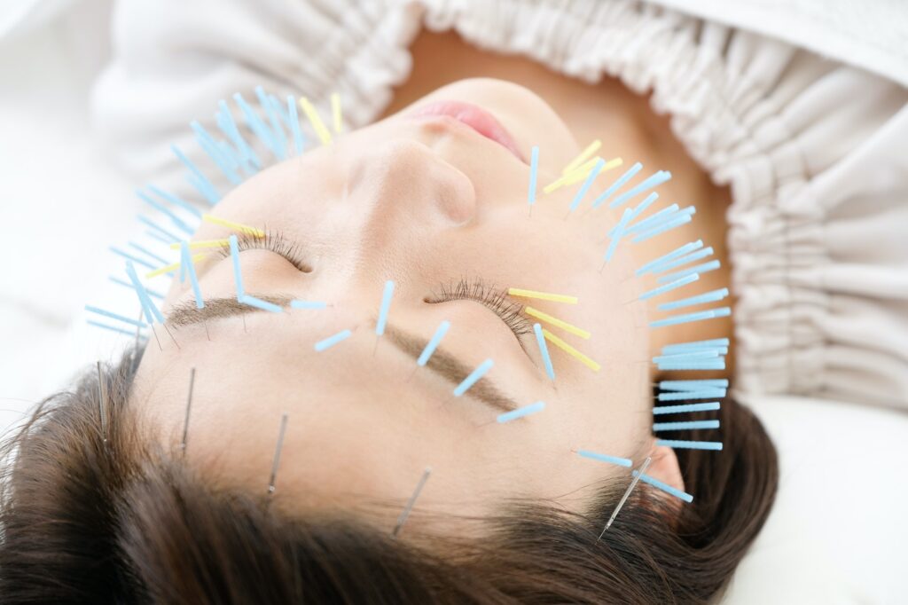 Up of a woman getting acupuncture on her face at an acupuncture clinic